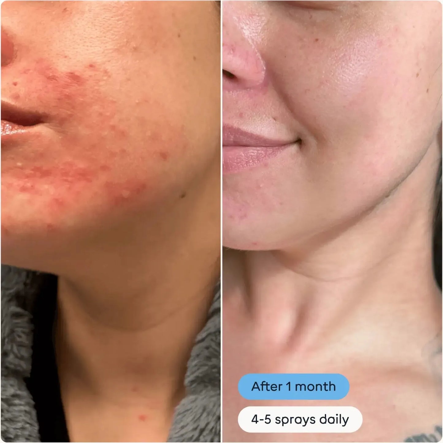 Magic Molecule Hypochlorous Acid Spray Mini before and after results showing reduced acne and clearer skin after 1 month of use with 4-5 sprays daily.
