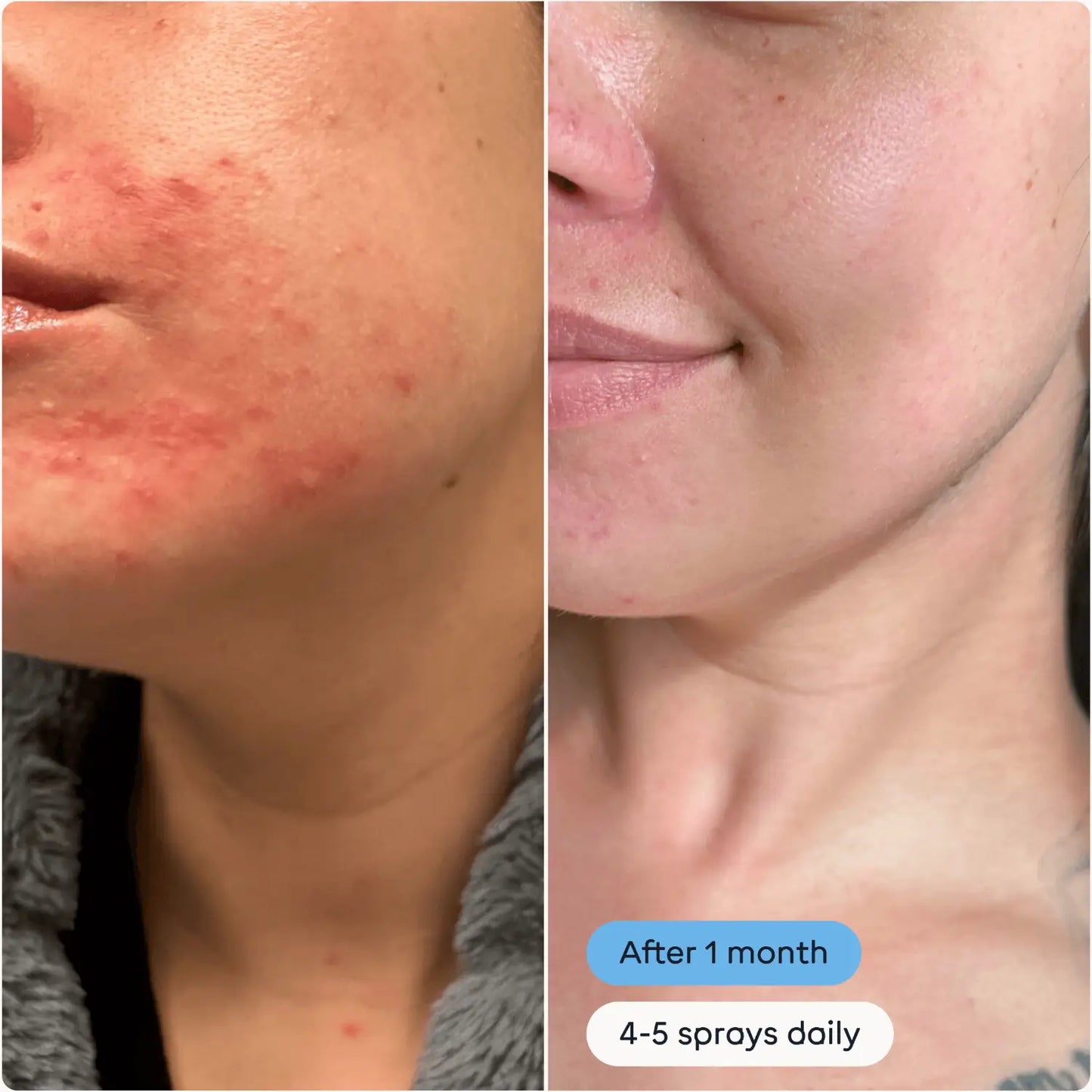 A person's face showing reduced acne and clearer skin after 1 month of use with 4-5 sprays daily of magic molecule as an acne treatment showing improvement after one month.