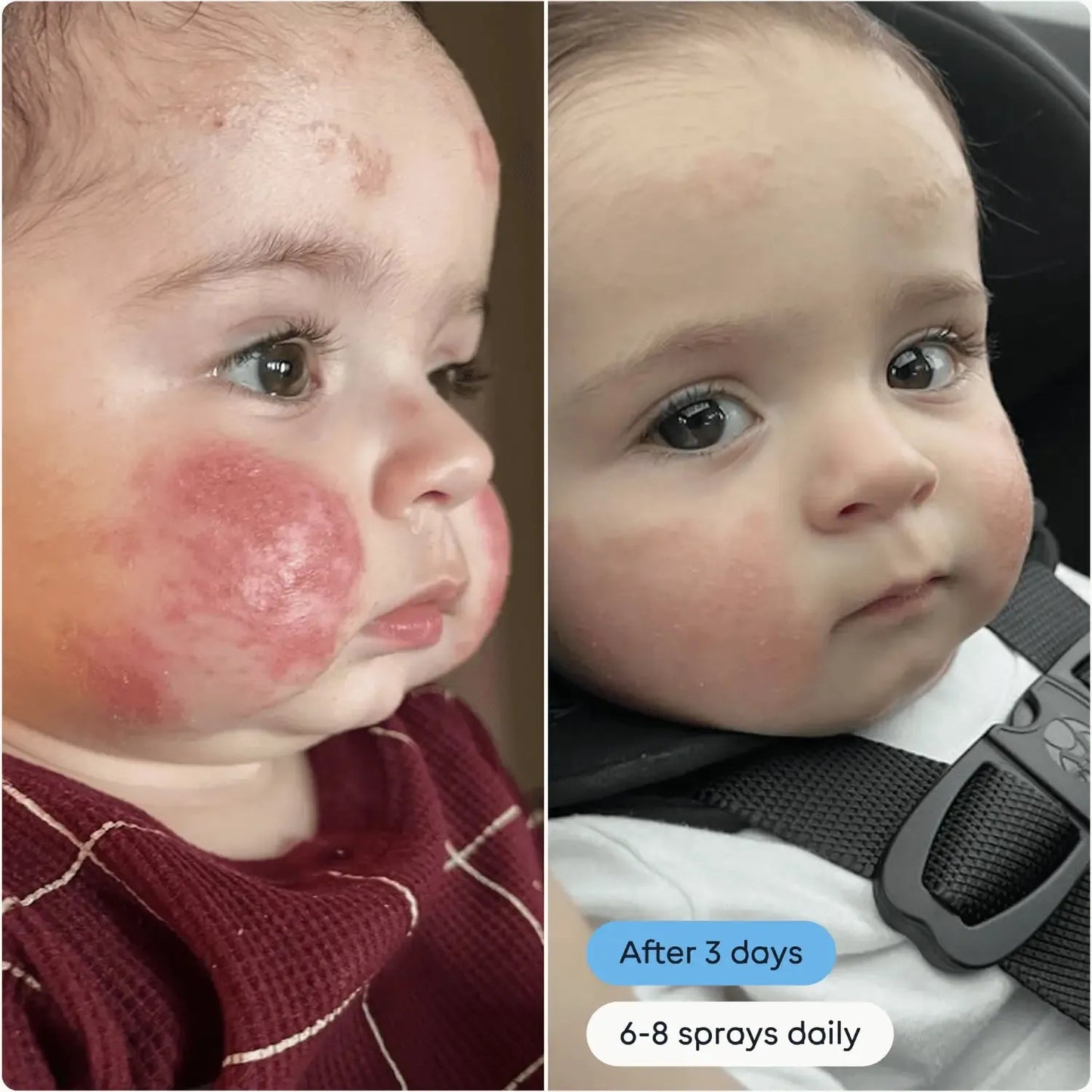 Before and after comparison of a child's skin condition after using magic molecule hypochlorous acid spray with text indicating improvement over 3 days.