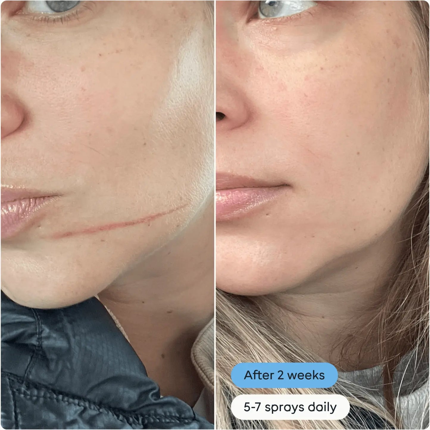 Before and after using Magic Molecule Hypochlorous Acid Spray Mini on facial scar, showing visible healing after 2 weeks with 5–7 sprays daily.