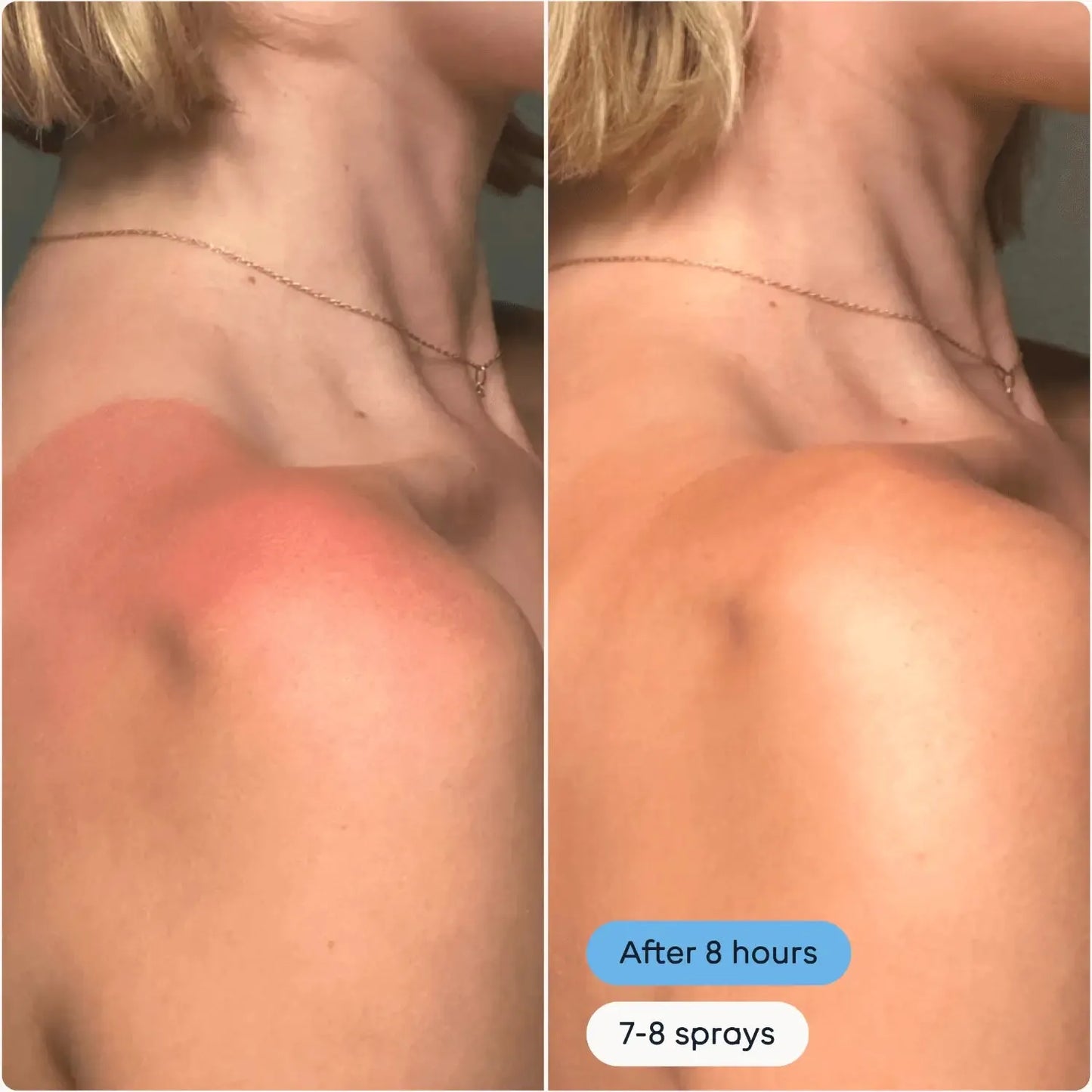 Magic Molecule Hypochlorous Acid Spray Mini before and after use on red irritated sunburned shoulder skin. Visible soothing effect after 8 hours and 7-8 sprays.