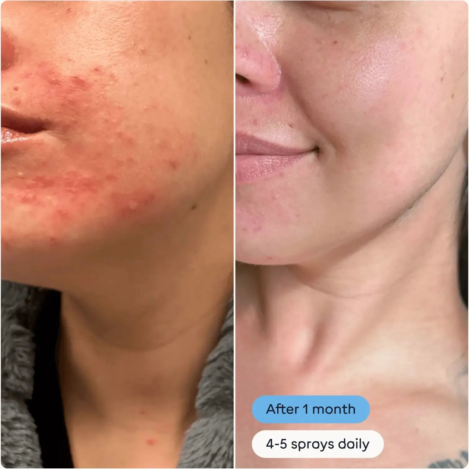 Magic Molecule Hypochlorous Acid Spray Mini before and after results showing reduced acne and clearer skin after 1 month of use with 4-5 sprays daily.