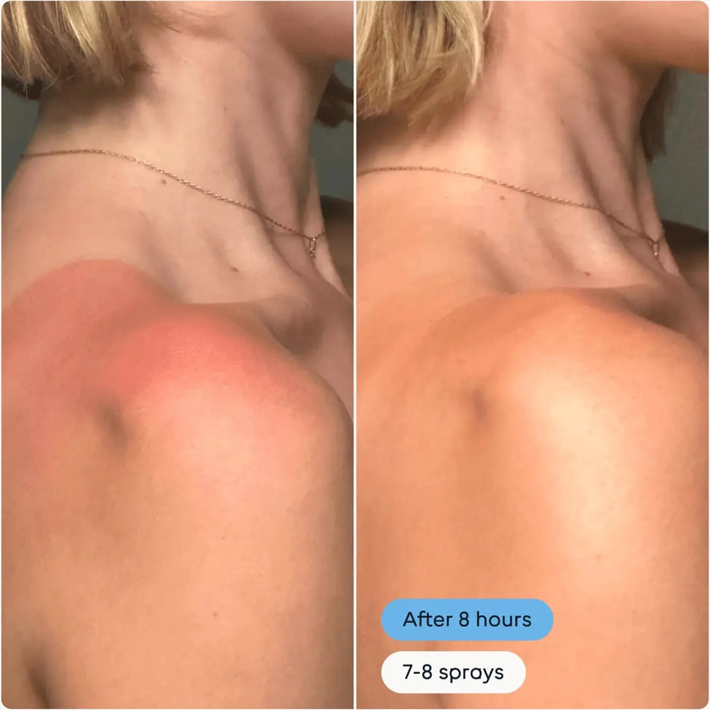Magic Molecule Hypochlorous Acid Spray Mini before and after use on red irritated sunburned shoulder skin. Visible soothing effect after 8 hours and 7-8 sprays.