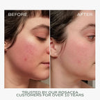 Fitglow Redness Rescue Cream Calming Color Corrector - Before and After of a woman's cheek showing reduced redness after use